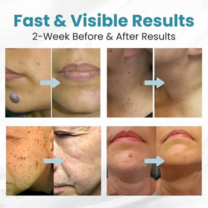 Non Invasive Mole & Wart Removal Pen