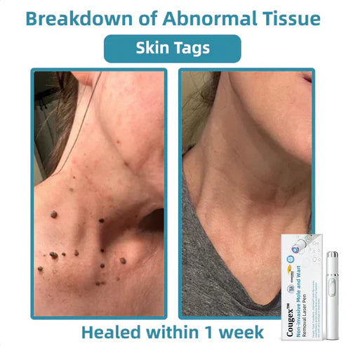 Non Invasive Mole & Wart Removal Pen