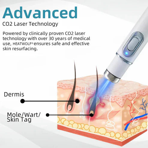 Non Invasive Mole & Wart Removal Pen