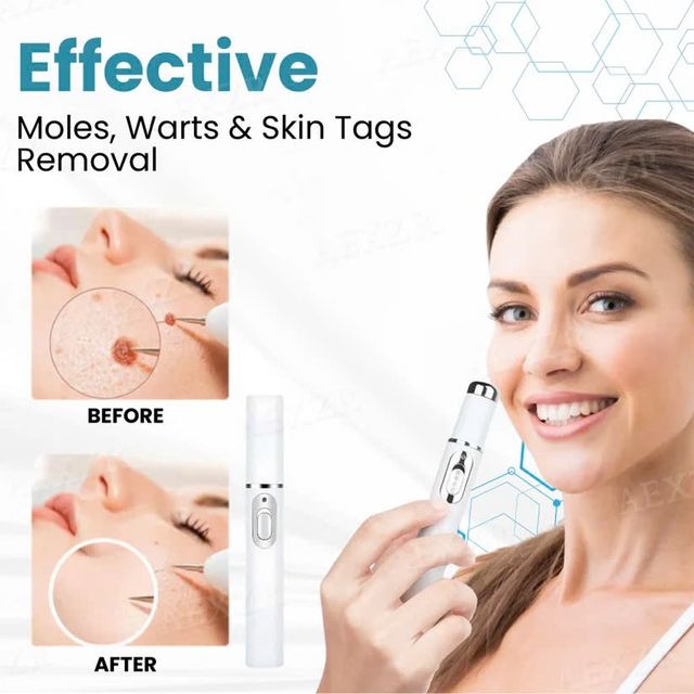 Non Invasive Mole & Wart Removal Pen