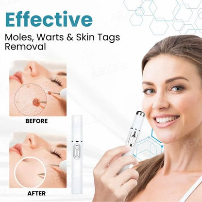 Non Invasive Mole & Wart Removal Pen