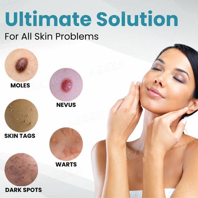 Non Invasive Mole & Wart Removal Pen